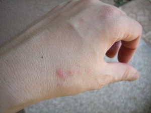 Bed bugs bite